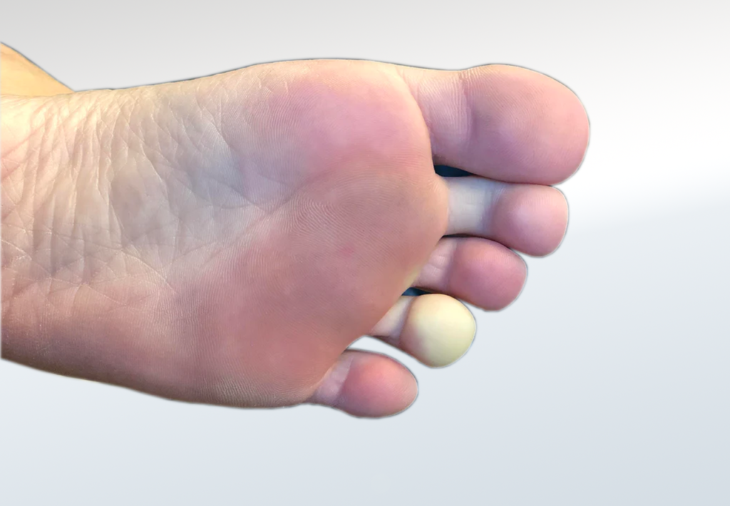 Understanding Diabetic Skin Conditions: Visual Guide - Diabetic Shoe - An Ortho Shoes Company