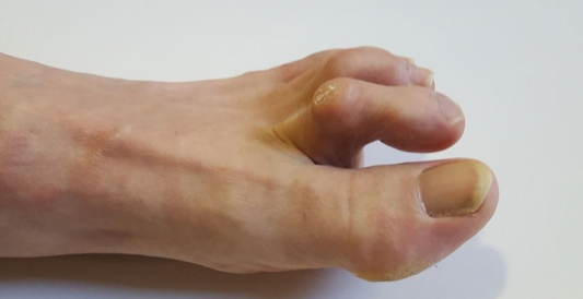 Understanding Claw Toe: Causes, Symptoms, and Practical Solutions for Foot Comfort - Diabetic Shoe - An Ortho Shoes Company