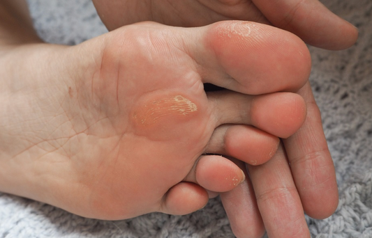 Corn Conundrum: Understanding, Treating, and Preventing Foot Corns for Softer, Happier Feet - Diabetic Shoe - An Ortho Shoes Company