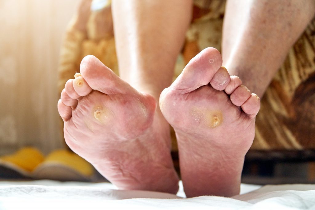 Comprehensive Foot Care Tips for Managing Diabetic Foot Ulcers - Diabetic Shoe - An Ortho Shoes Company