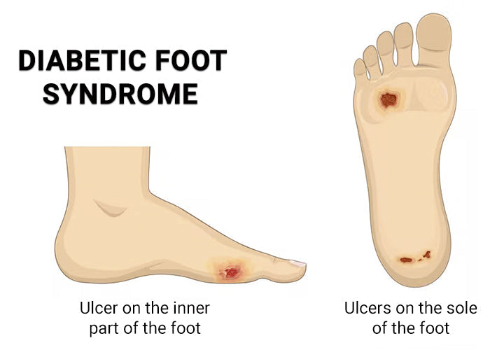 Comprehensive Management of Diabetic Foot Syndrome - Diabetic Shoe - An Ortho Shoes Company