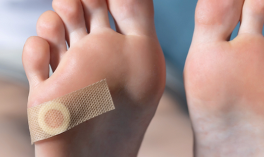 Navigating Foot Warts: When to Seek Specialist Care - Diabetic Shoe - An Ortho Shoes Company