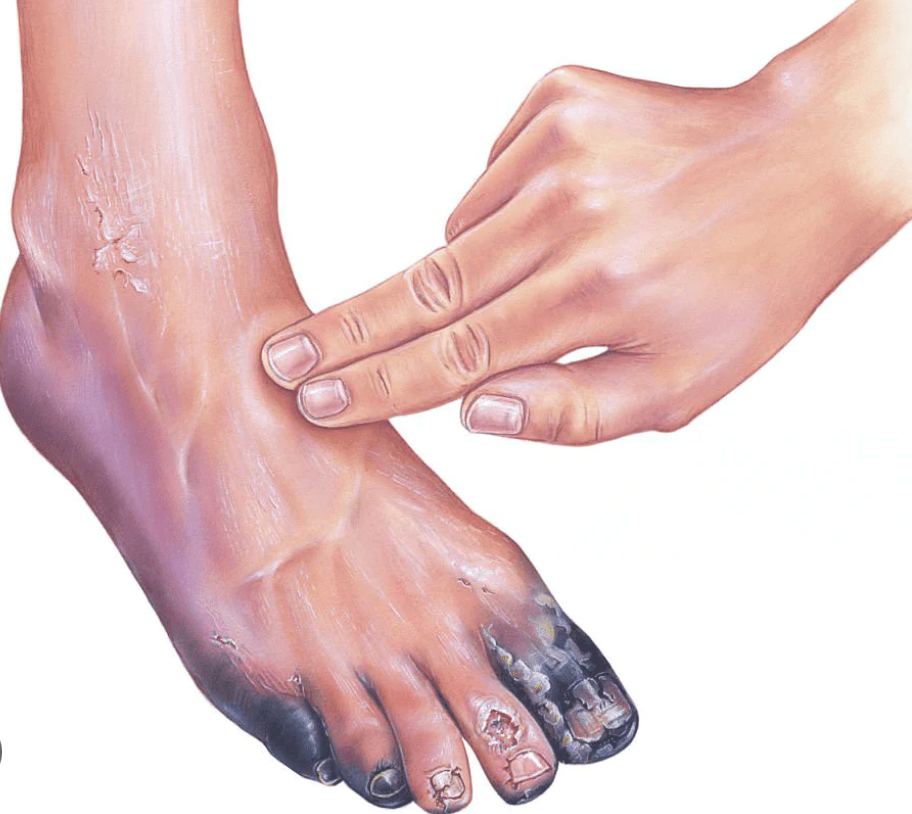 Gangrene in Diabetic Feet: Causes, Symptoms, and Treatment – Diabetic ...