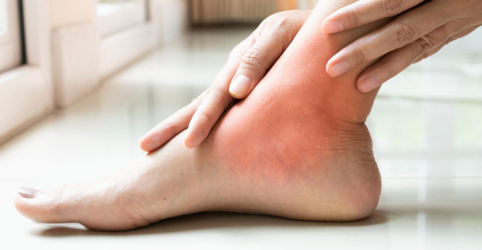 Keep Gout Flare-ups at Bay: 5 Practical Tips for Prevention - Diabetic Shoe - An Ortho Shoes Company