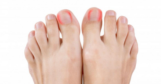 Ingrown toenail