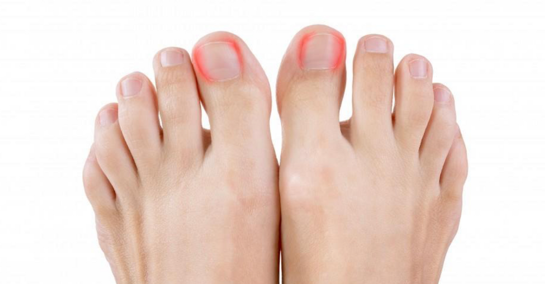 Ingrown Toenail Dilemma: Will It Heal on Its Own or Need Professional Care? - Diabetic Shoe - An Ortho Shoes Company