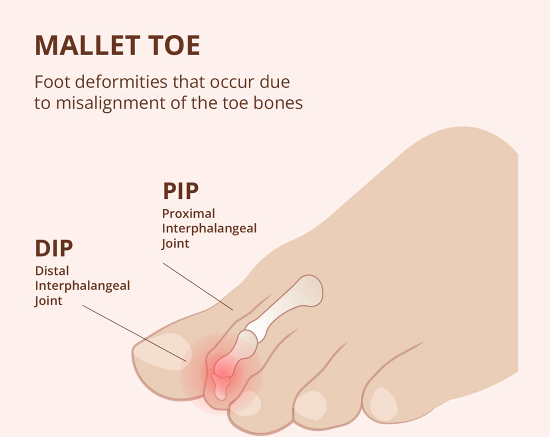 Mallet Toes explained 