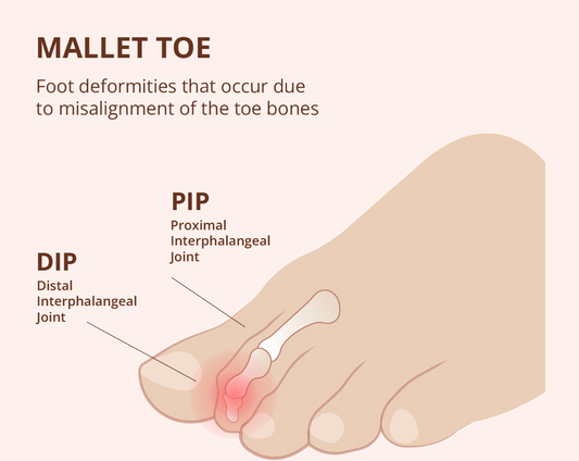 Hammer Toes and Mallet Toes: Causes, Symptoms, and Strategies for Toe Comfort - Diabetic Shoe - An Ortho Shoes Company