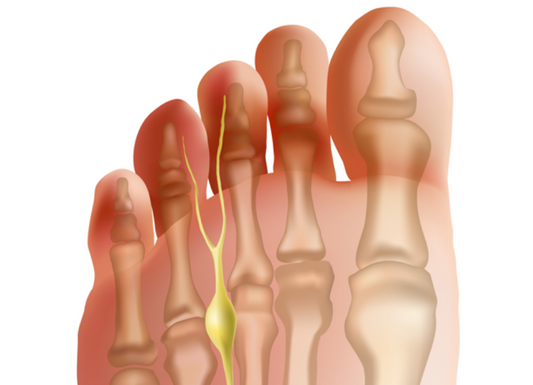 Morton's Neuroma