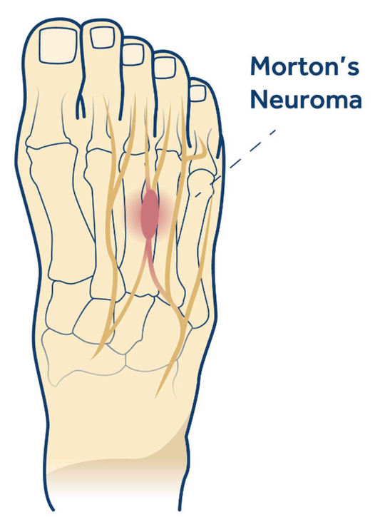 Morton’s Neuroma