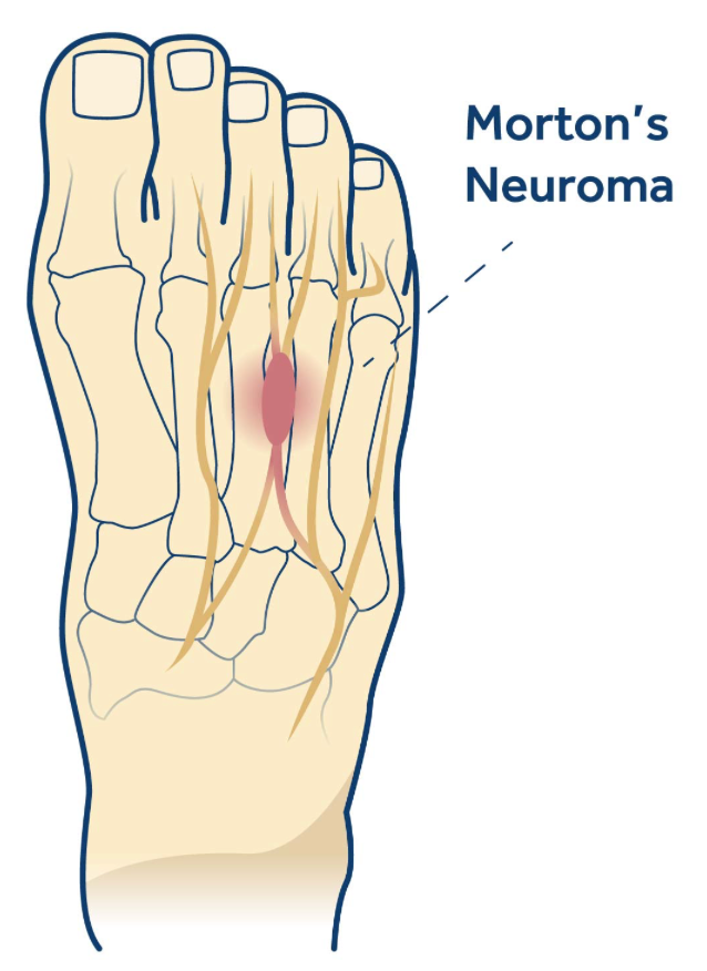 Relieve Morton’s Neuroma Pain with Orthotics: A Comprehensive Guide - Diabetic Shoe - An Ortho Shoes Company