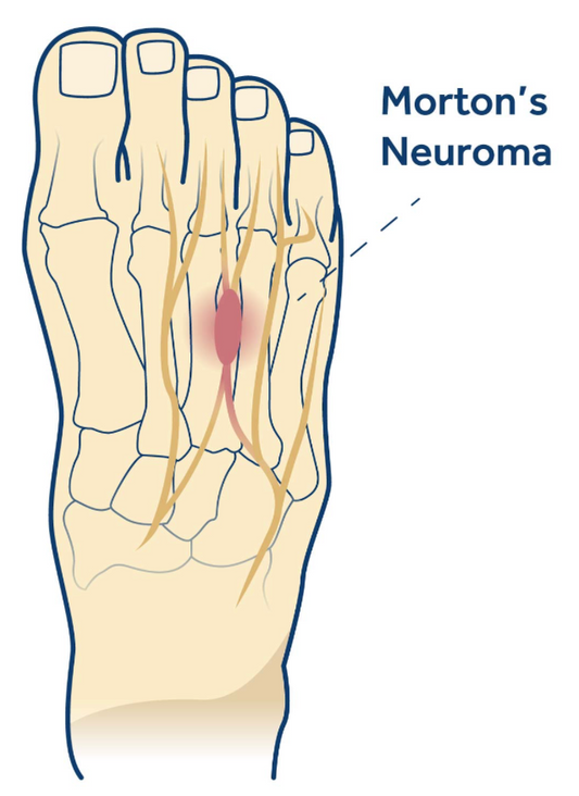 Relieve Morton’s Neuroma Pain with Orthotics: A Comprehensive Guide - Diabetic Shoe - An Ortho Shoes Company
