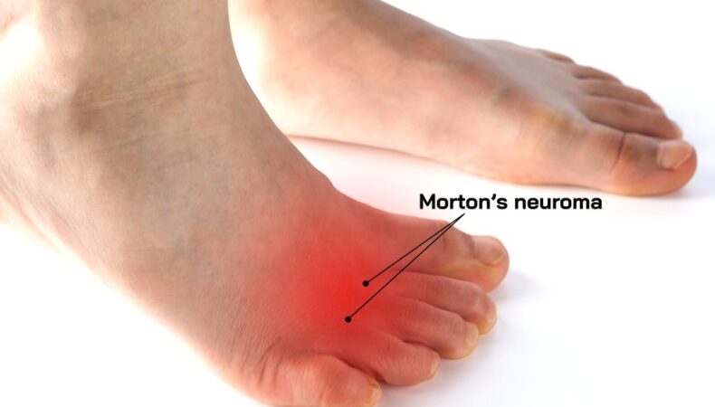 Mortons-Neuroma-Foot-pain