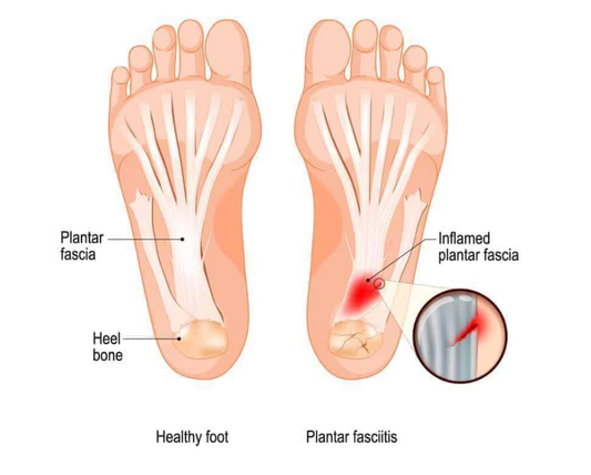 plantar-fasciitis