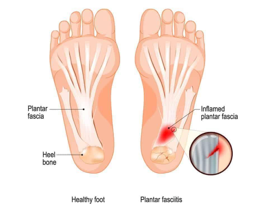 What is Plantar Fasciitis? Causes, Symptoms, Treatments - Diabetic Shoe - An Ortho Shoes Company