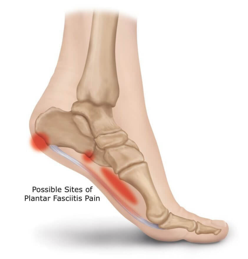 Plantar fasciitis