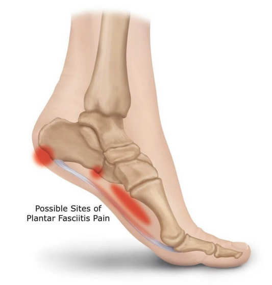 Heel Pain Unveiled: Navigating Plantar Fasciitis for a Comfortable Stride - Diabetic Shoe - An Ortho Shoes Company