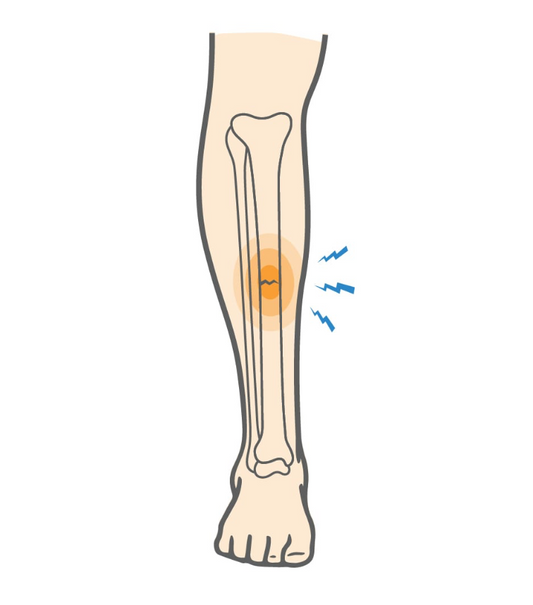 Stress Fractures