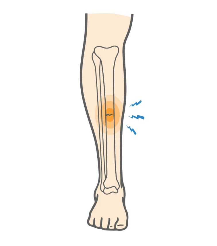 Navigating Stress Fractures in Sports: Risks, Prevention, and Recovery - Diabetic Shoe - An Ortho Shoes Company