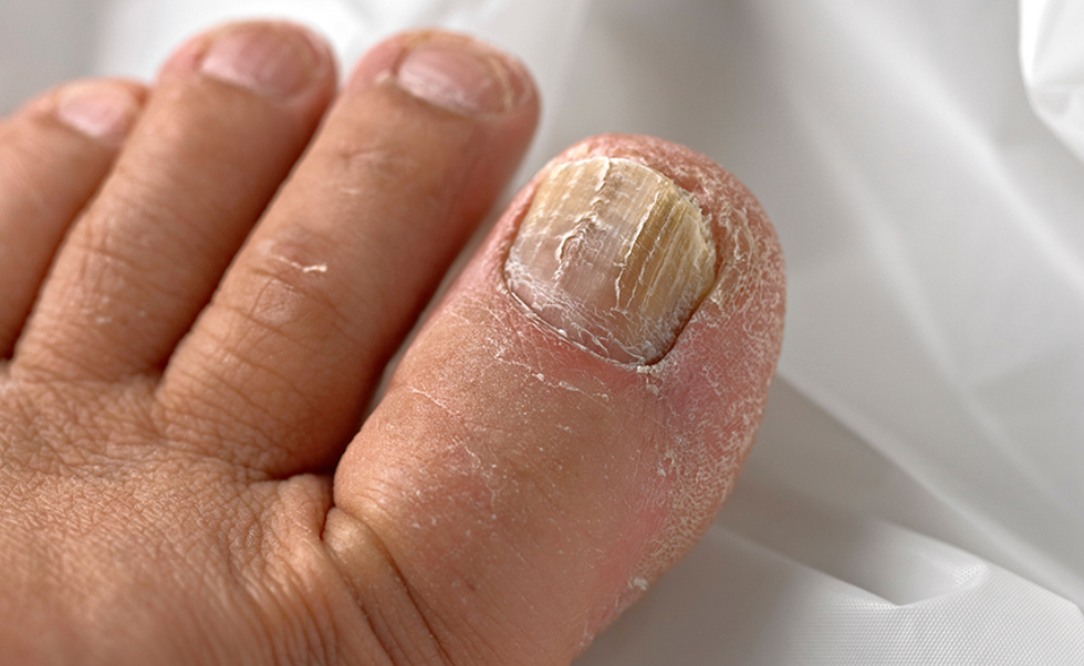 Conquer Embarrassing Toenail Fungus: A Guide to Treatment and Prevention - Diabetic Shoe - An Ortho Shoes Company