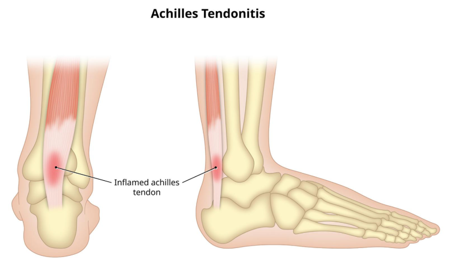 Understanding and Managing Achilles Tendinitis Pain