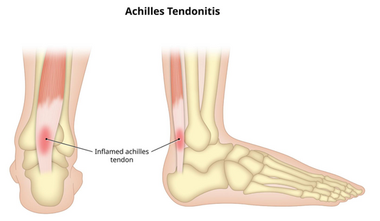 Understanding and Managing Achilles Tendinitis Pain