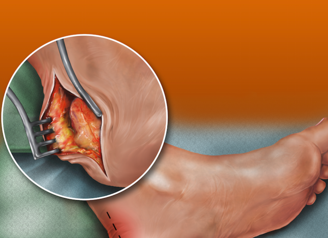Understanding Partial Achilles Tears: Symptoms and Treatment