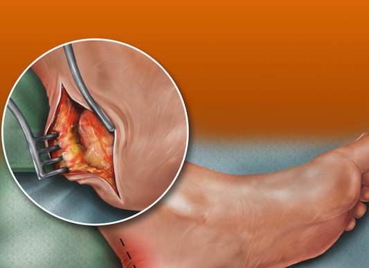 Understanding Partial Achilles Tears: Symptoms and Treatment