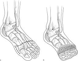Understanding Forefoot Amputation: Causes and Recovery - Diabetic Shoe - An Ortho Shoes Company