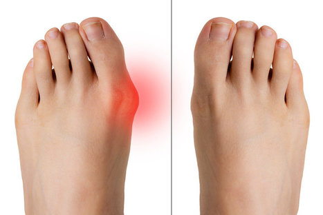 HOW ORTHOPEDIC SHOES WITH WIDE TOE BOXES RELIEVE PRESSURE ON BUNIONS