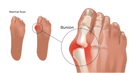 Battling Bunions: Understanding, Treating, and Preventing Foot Bunions for Happy, Healthy Feet - Diabetic Shoe - An Ortho Shoes Company
