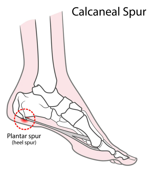 calcaneal-spurs