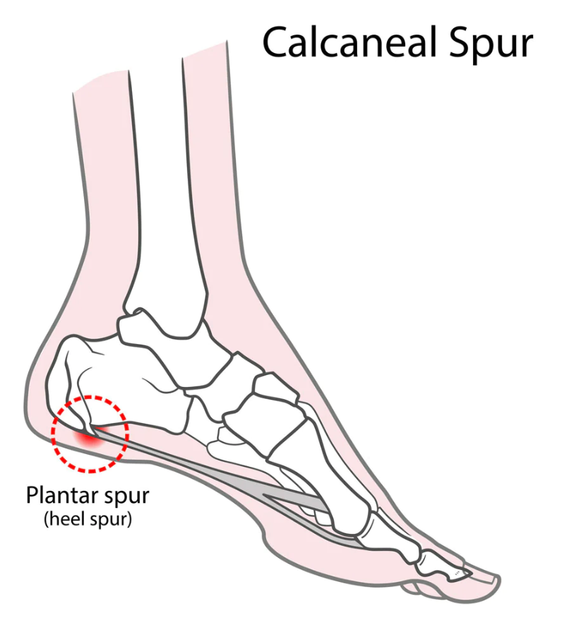 Managing Calcaneal Spurs: Treatment Options and Tips - Diabetic Shoe - An Ortho Shoes Company