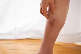 Understanding Cellulitis in Diabetic Patients - Diabetic Shoe - An Ortho Shoes Company