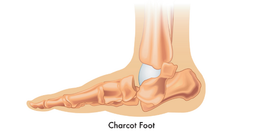 Navigating Charcot's Foot: Diagnosis, Treatment, and Specialized Care - Diabetic Shoe - An Ortho Shoes Company