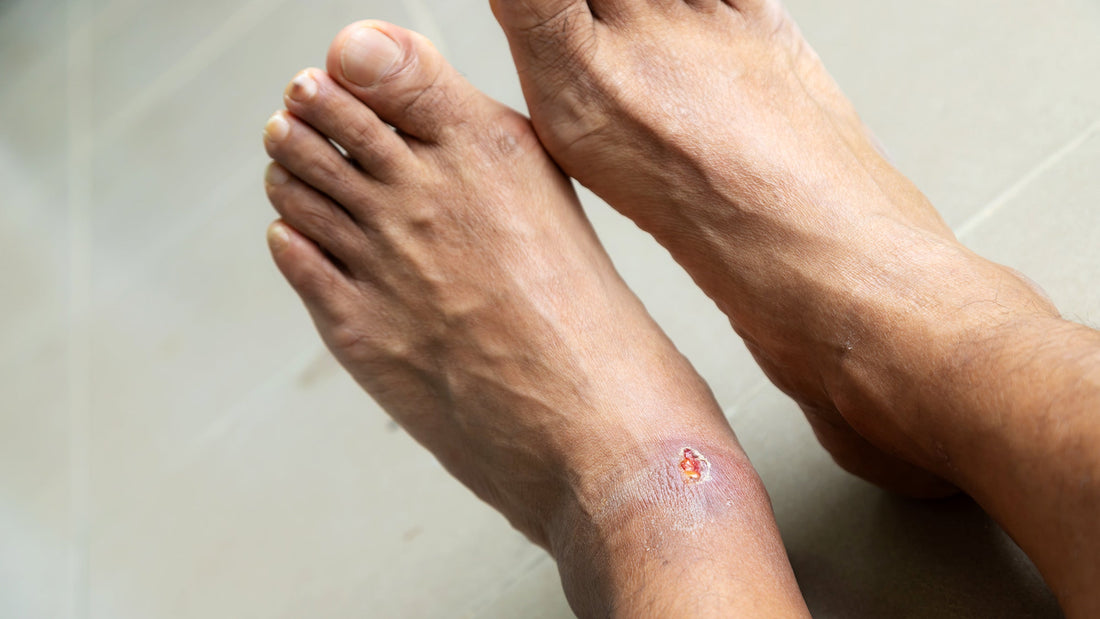 Understanding and Managing Diabetic Foot Ulcers: Factors Influencing Severity - Diabetic Shoe - An Ortho Shoes Company