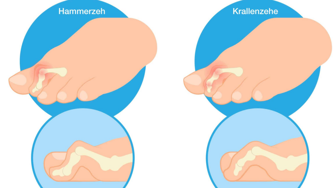 deformities-of-toes