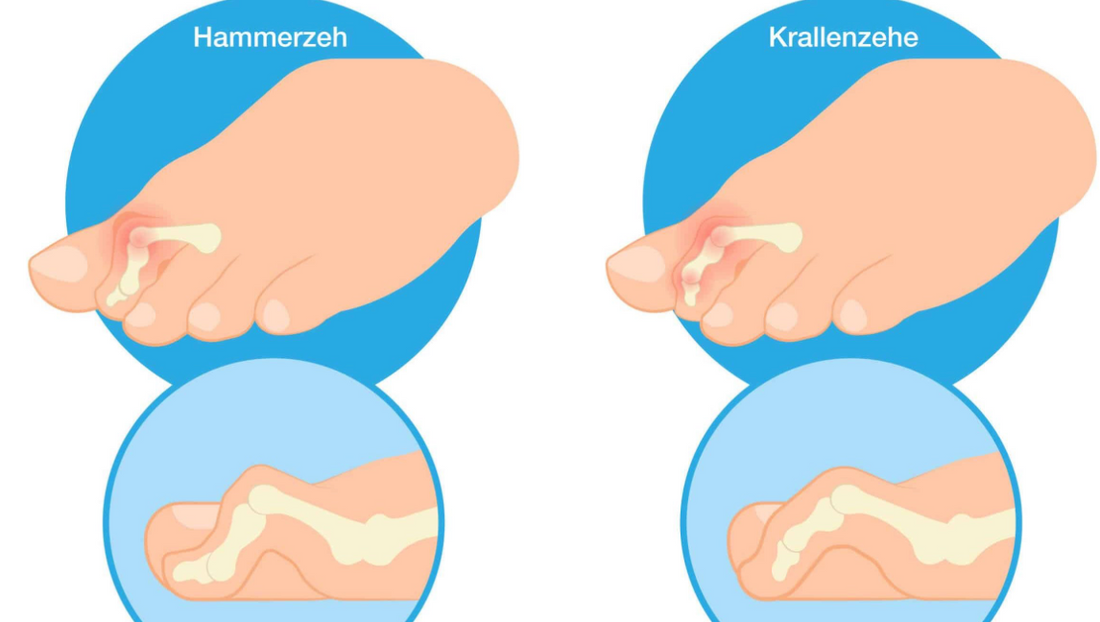 Deformities of Toes: Hallux Valgus, Hallux Rigidus, and Hammer Toe - Diabetic Shoe - An Ortho Shoes Company