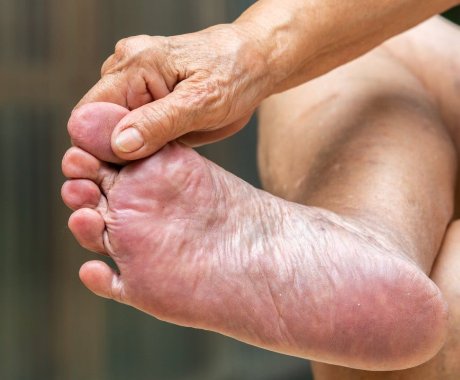 Guarding Foot Health: The Impact of Diabetes on Men’s and Women’s Feet - Diabetic Shoe - An Ortho Shoes Company