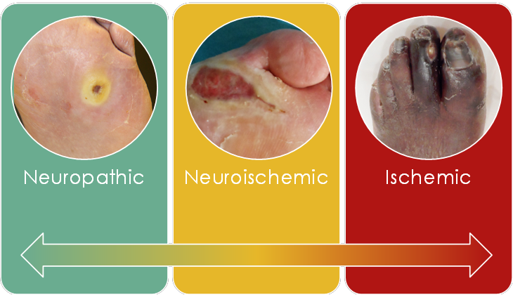 Deciphering Diabetic Foot: Understanding Neuropathic and Neuroischemic Conditions - Diabetic Shoe - An Ortho Shoes Company