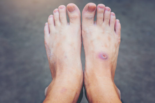 diabetic-foot-ulcer