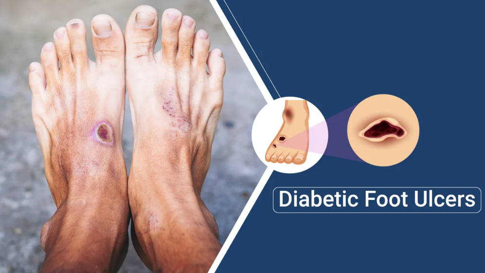 Diabetic Foot Ulcers: Causes, Prevention, and Management Strategies ...