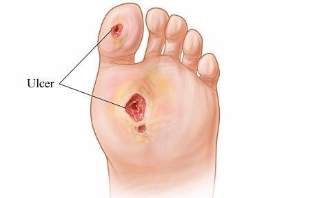 Mastering Diabetic Foot Ulcer Care: Strategies for Swift Healing and Innovative Interventions - Diabetic Shoe - An Ortho Shoes Company