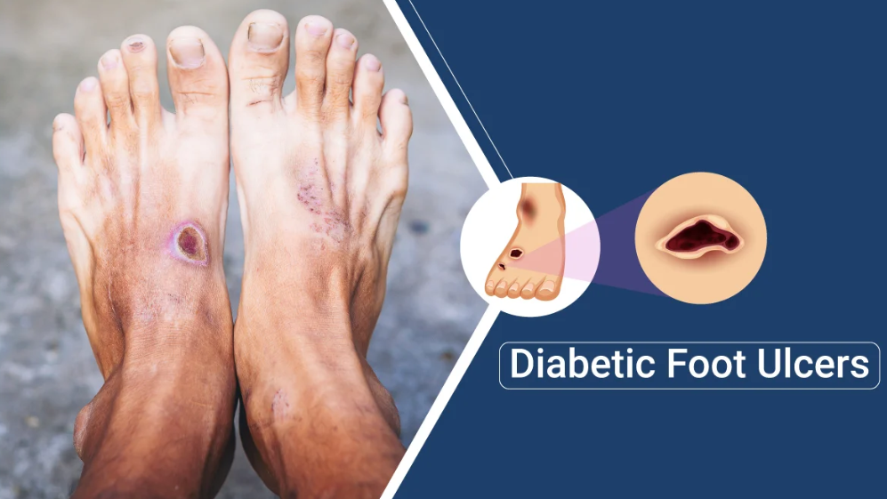 Understanding and Managing Diabetic Foot Ulcers: Factors, Evaluation, and Interventions - Diabetic Shoe - An Ortho Shoes Company