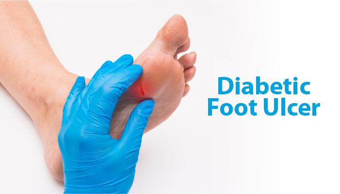 Understanding Diabetic Foot Ulcers: Risks, Implications, and Prevention Strategies - Diabetic Shoe - An Ortho Shoes Company