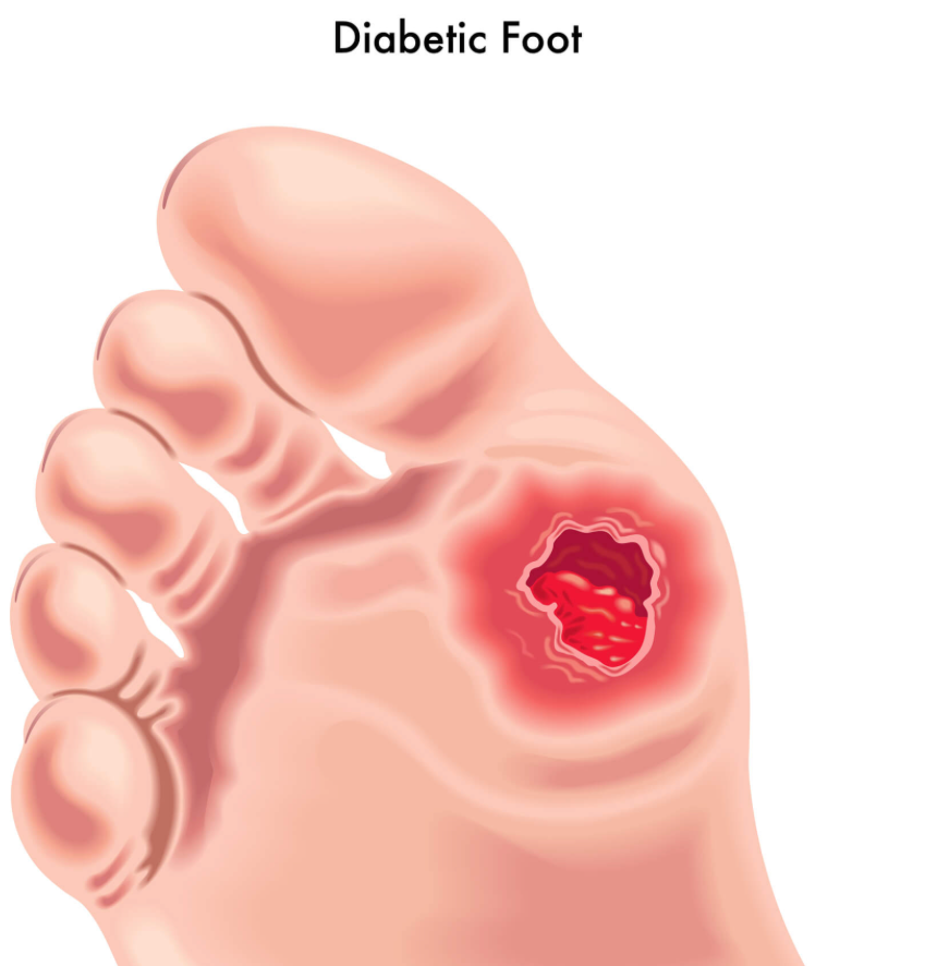  diabetic-foot-wounds 