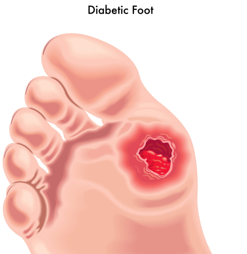 Decoding the Challenge: Why Diabetic Foot Wounds Struggle to Heal - Diabetic Shoe - An Ortho Shoes Company
