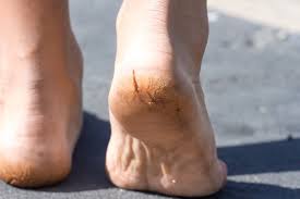 Preventing and Treating Diabetic Foot Cracks - Diabetic Shoe - An Ortho Shoes Company