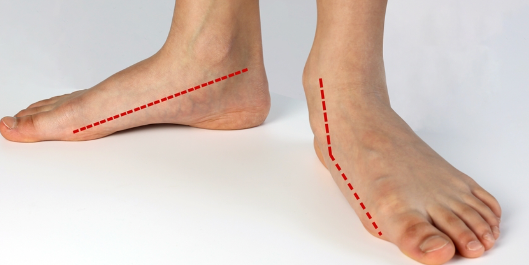 Understanding Flat Feet: Symptoms, Causes, and Comfortable Solutions - Diabetic Shoe - An Ortho Shoes Company