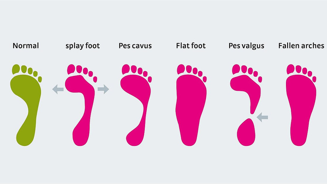 ROLE OF FOOTWEAR IN PREVENTING LONG TERM  FOOT DEFORMITIES